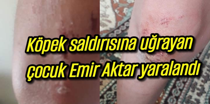 Köpek saldırısına uğrayan Emir aktar yaralandı